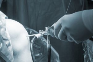 Shoulder Arthrosopy