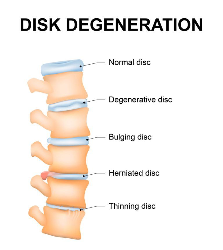 degenerative-disc-disease-fresno-orthopedist-orthopedic-surgery